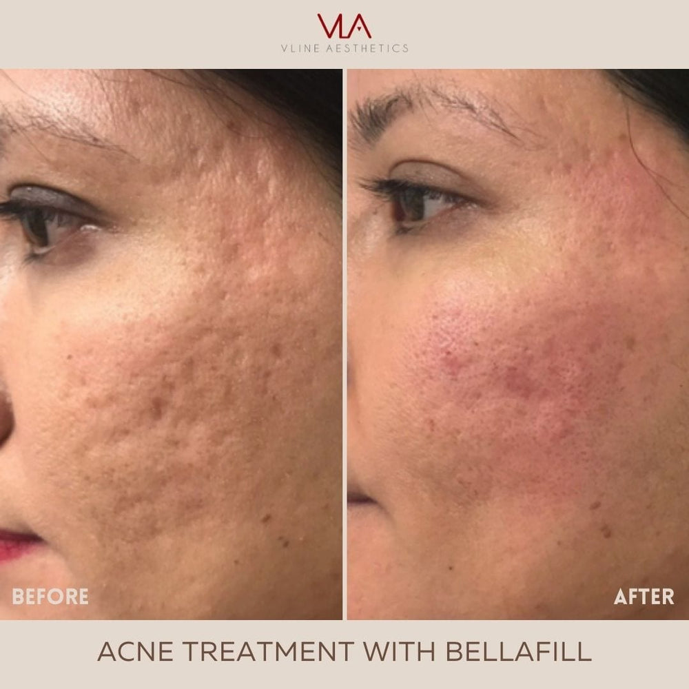 Acne Scars   1 Bellafill 