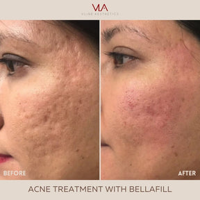 Acne Scars / 1 Bellafill (BOGO) - Skin Perfect Brothers Powered by VLA