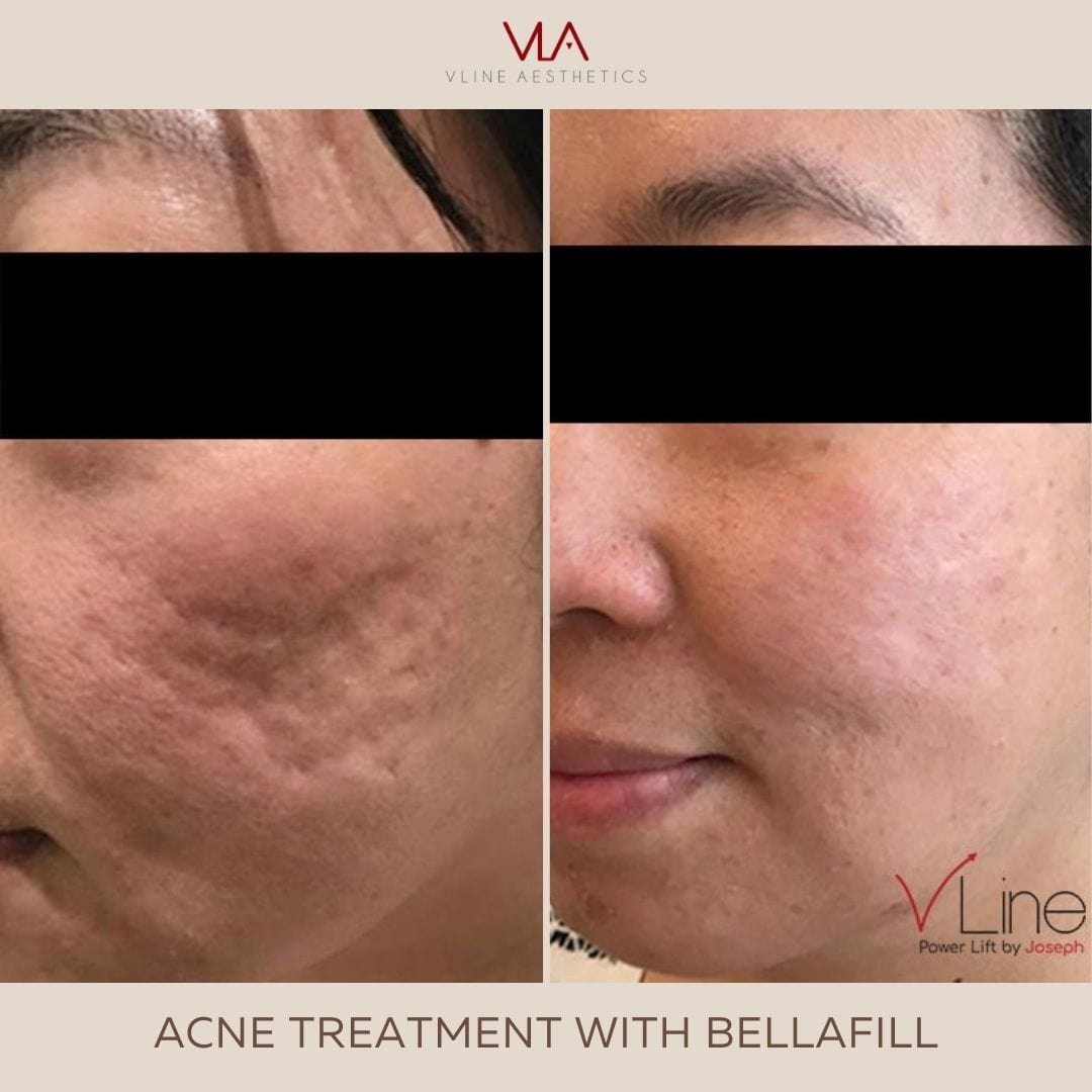 Acne Scars / 1 Bellafill (BOGO) - Skin Perfect Brothers Powered by VLA