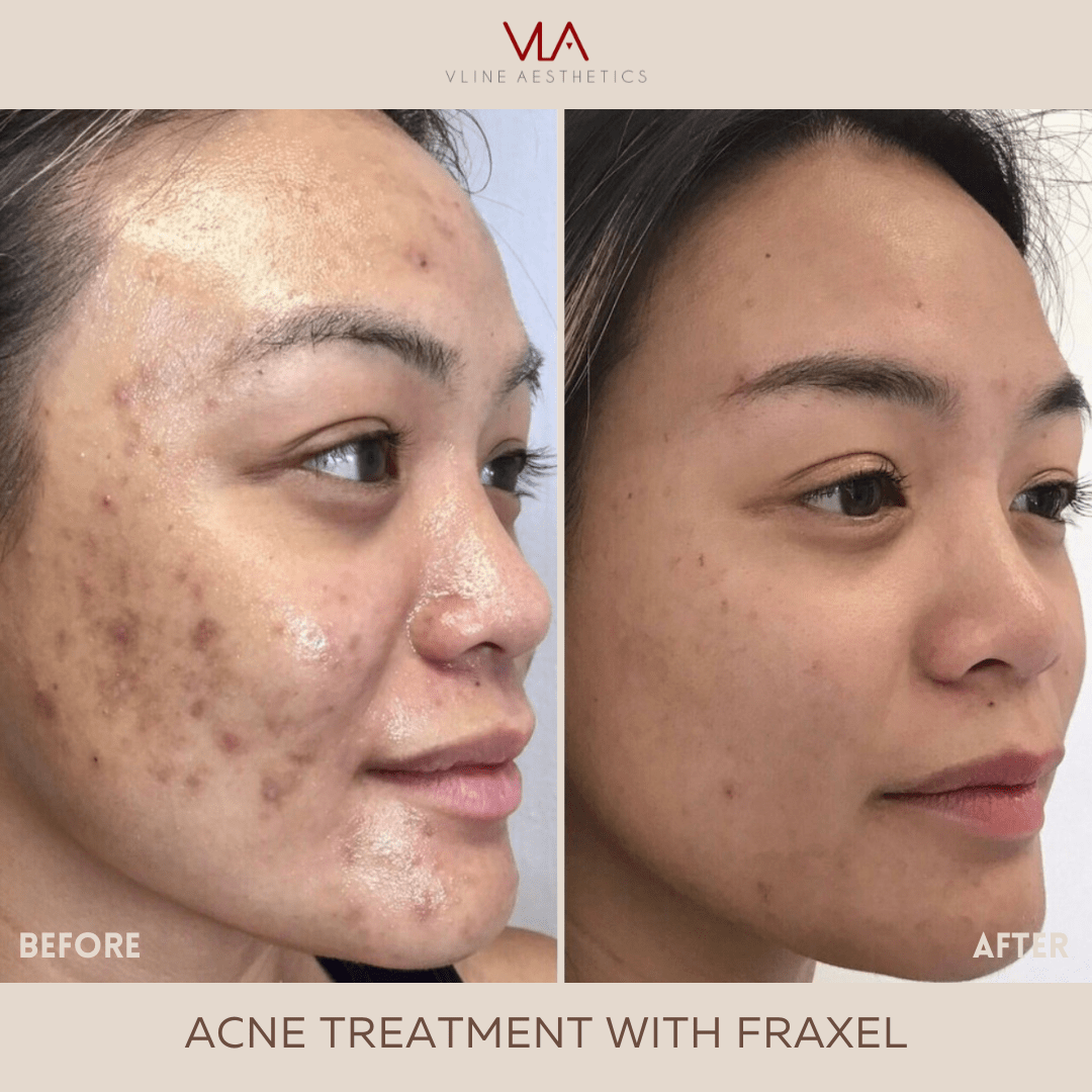 Froxle Fraxel Acne Scars Before And After