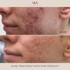 Acne scars, Wrinkles, Facial Rejuvenation / Laser Genesis - Skin Perfect Brothers Powered by VLA