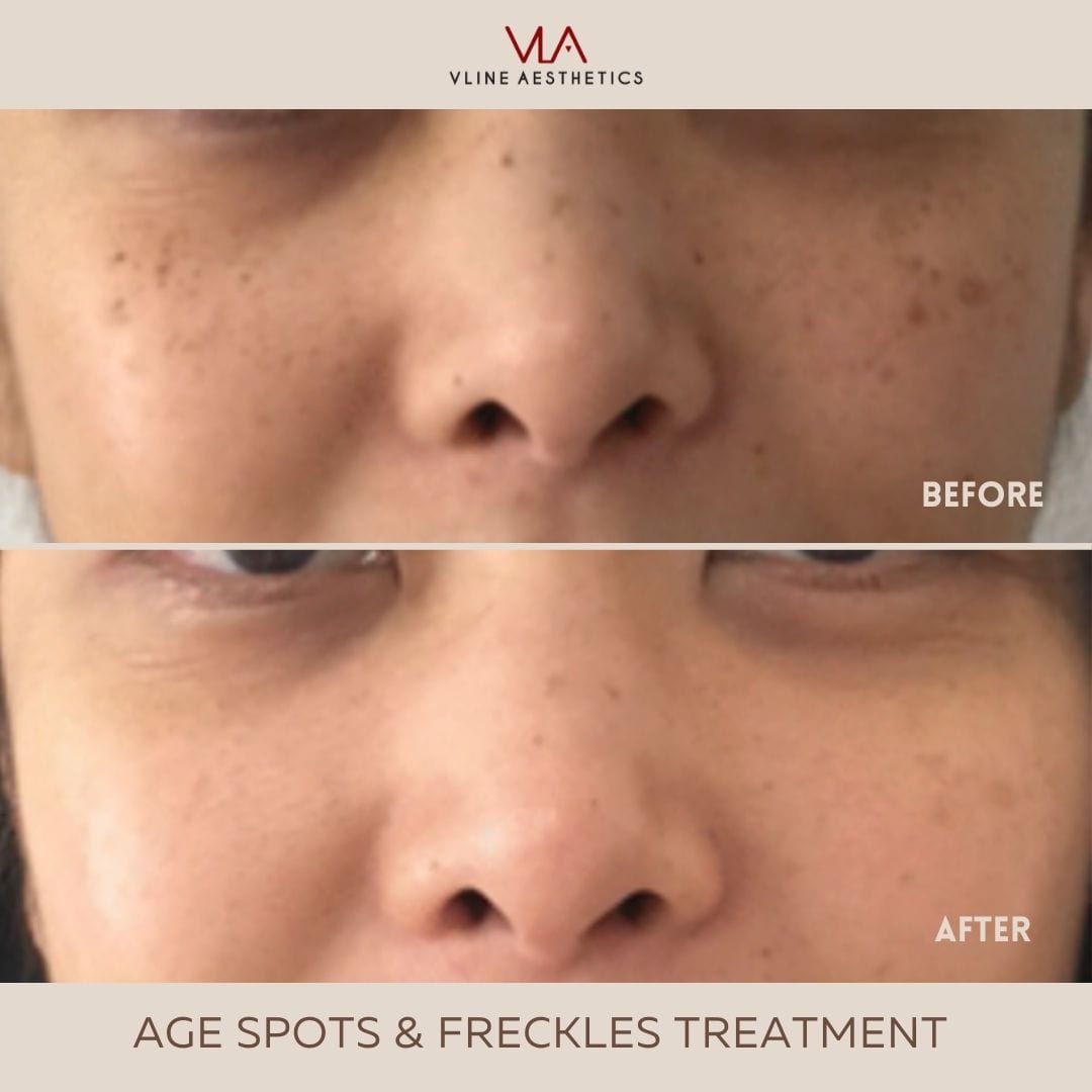 Age Spots and Freckles / 2 IPL - Skin Perfect Brothers Powered by VLA