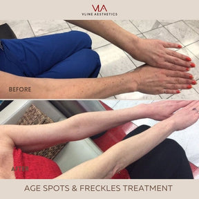 Age Spots and Freckles / 2 IPL - Skin Perfect Brothers Powered by VLA