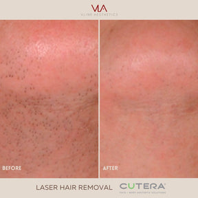 Laser Hair Removal Treatments - Skin Perfect Brothers Powered by VLA