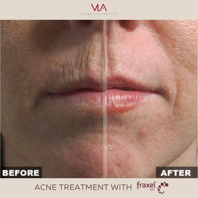 Acne Scars, Resurfacing / 1 Fraxel - Skin Perfect Brothers Powered by VLA