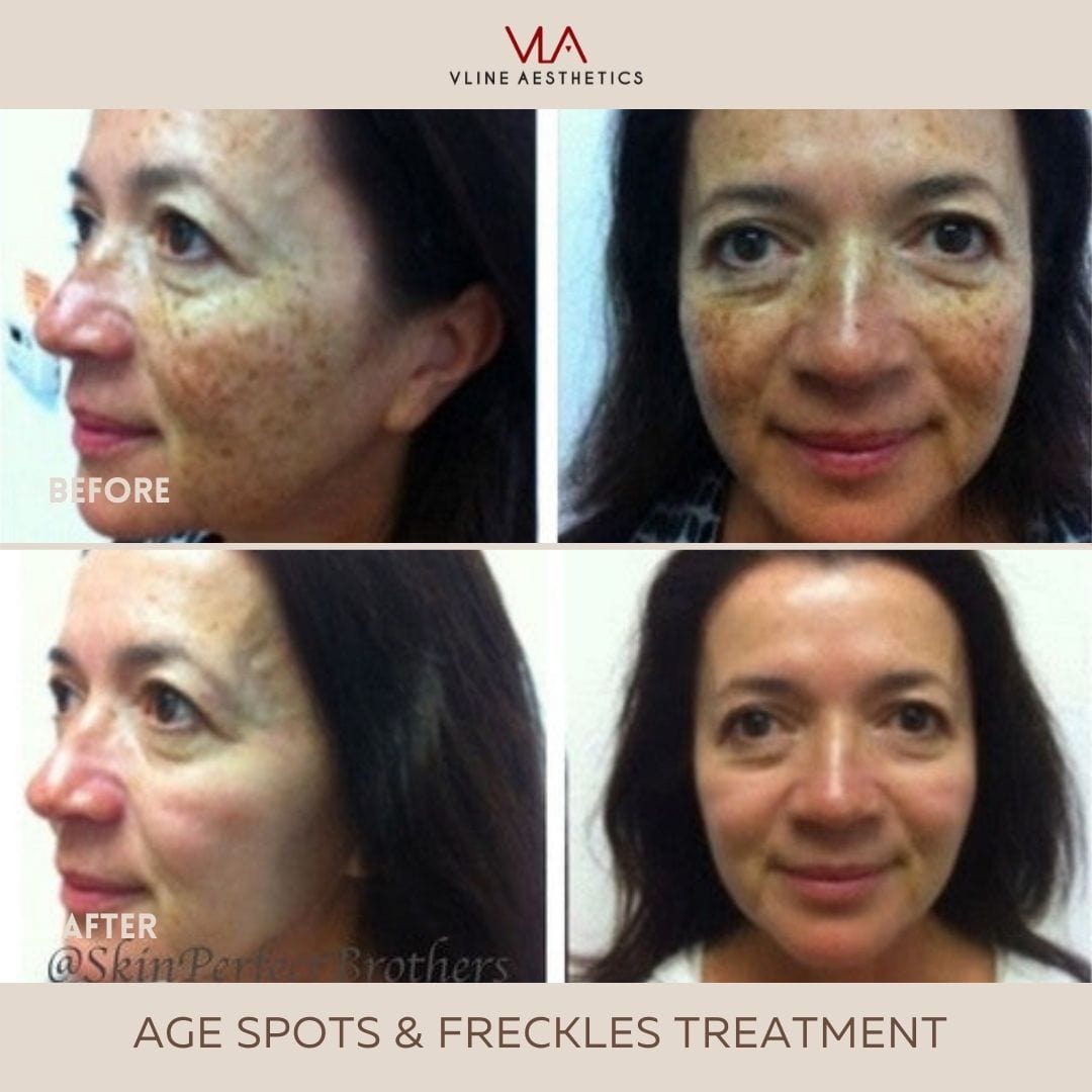 Age Spots and Freckles / 2 IPL - Skin Perfect Brothers Powered by VLA