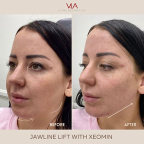 Ultherapy Package - Skin Perfect Brothers Powered by VLA