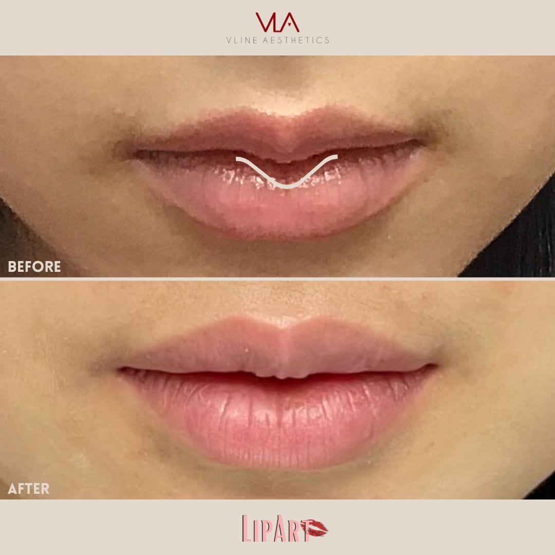 Lip Art - Skin Perfect Brothers Powered by VLA