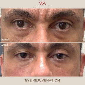 Eye Rejuvenation (Comfort Blend Filler) - Skin Perfect Brothers Powered by VLA