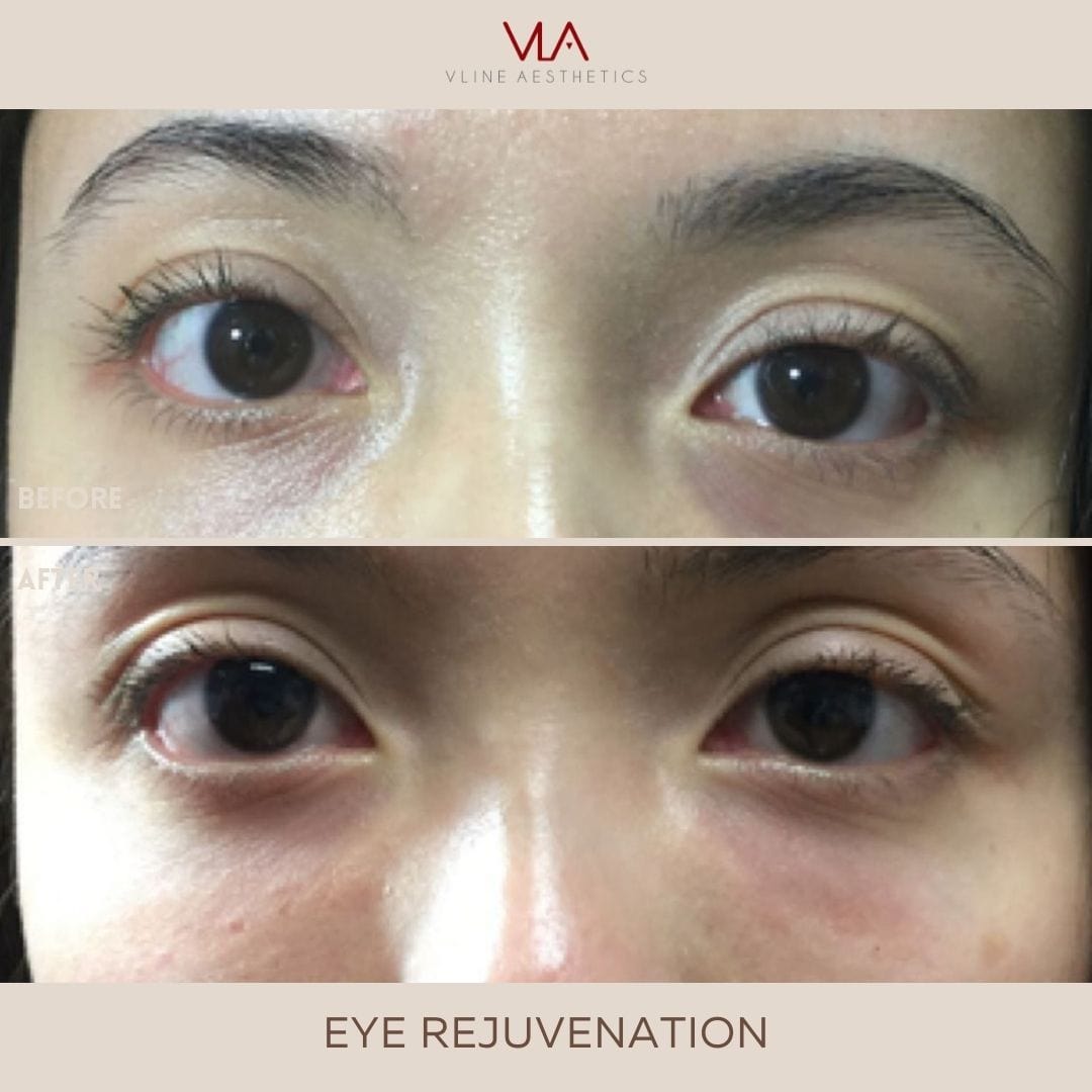 Eye Rejuvenation (Comfort Blend Filler) - Skin Perfect Brothers Powered by VLA