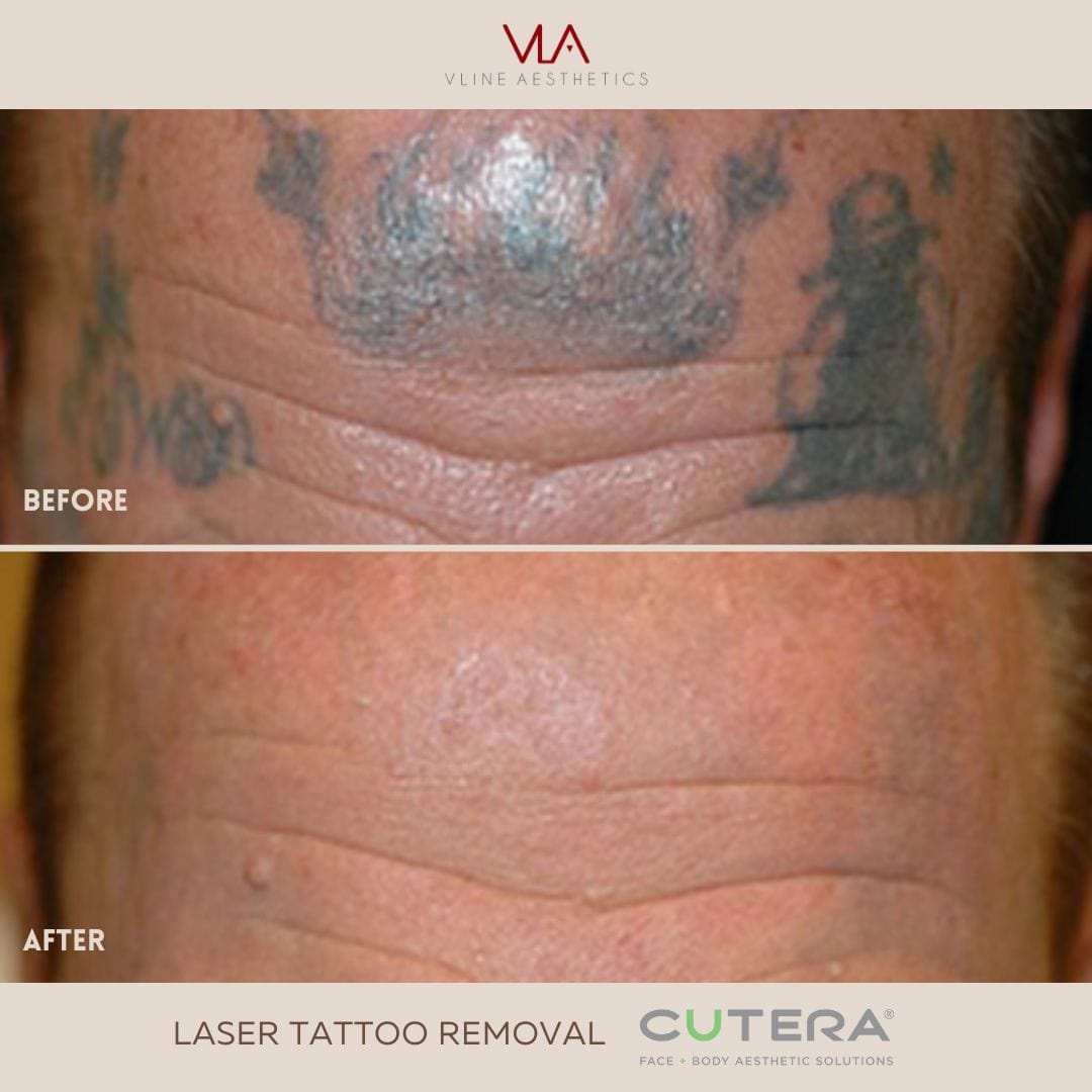 Tattoo Removal / 6 Spectra Treatments - Skin Perfect Brothers Powered by VLA