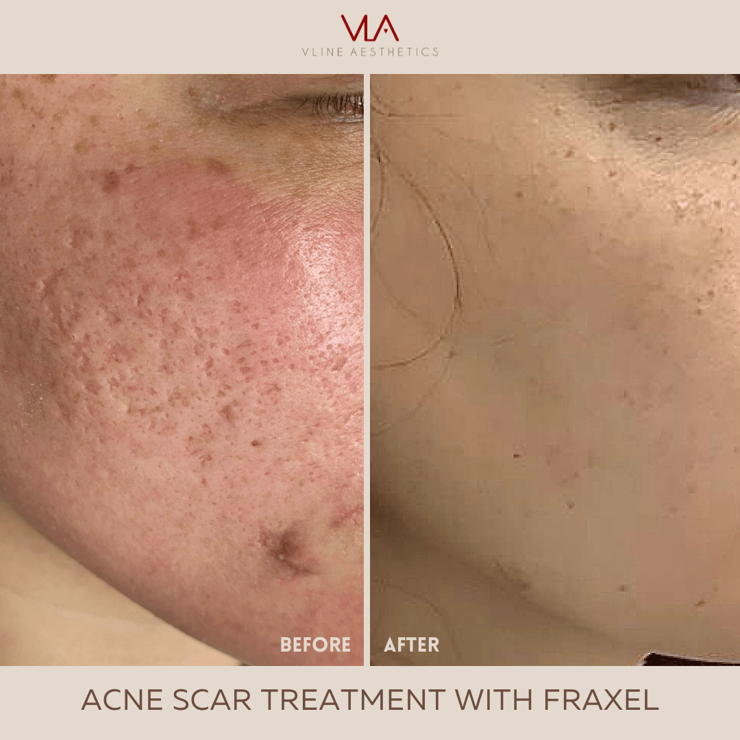 Froxle Fraxel Vs Co2 Laser For Acne Scars – LQUBI
