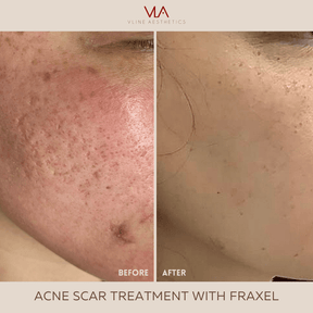 Acne Scars, Resurfacing / 1 Fraxel - Skin Perfect Brothers Powered by VLA