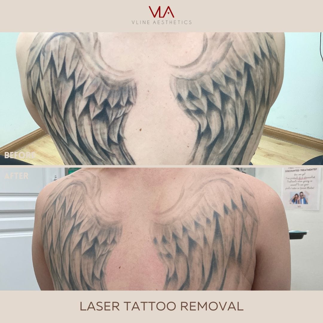 Tattoo Removal / 6 Spectra Treatments - Skin Perfect Brothers Powered by VLA