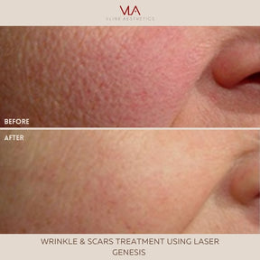 Acne scars, Wrinkles, Facial Rejuvenation / Laser Genesis - Skin Perfect Brothers Powered by VLA