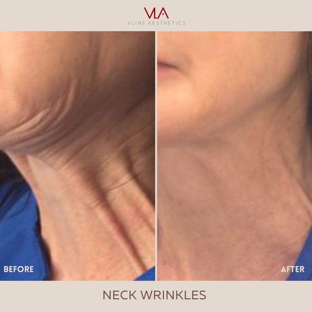20, 40, 60, or 100 Units of Xeomin (More Pure than Botox) - Skin Perfect Brothers Powered by VLA