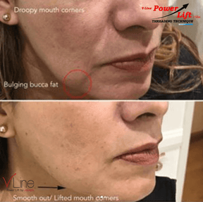 PDO Threads Lower Face (Pick me up) - Skin Perfect Brothers Powered by VLA