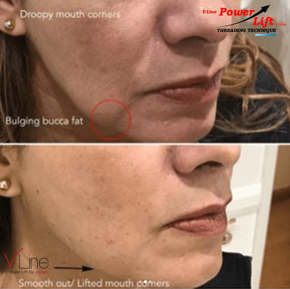 PDO Threads Lower Face (Pick me up) - Skin Perfect Brothers Powered by VLA