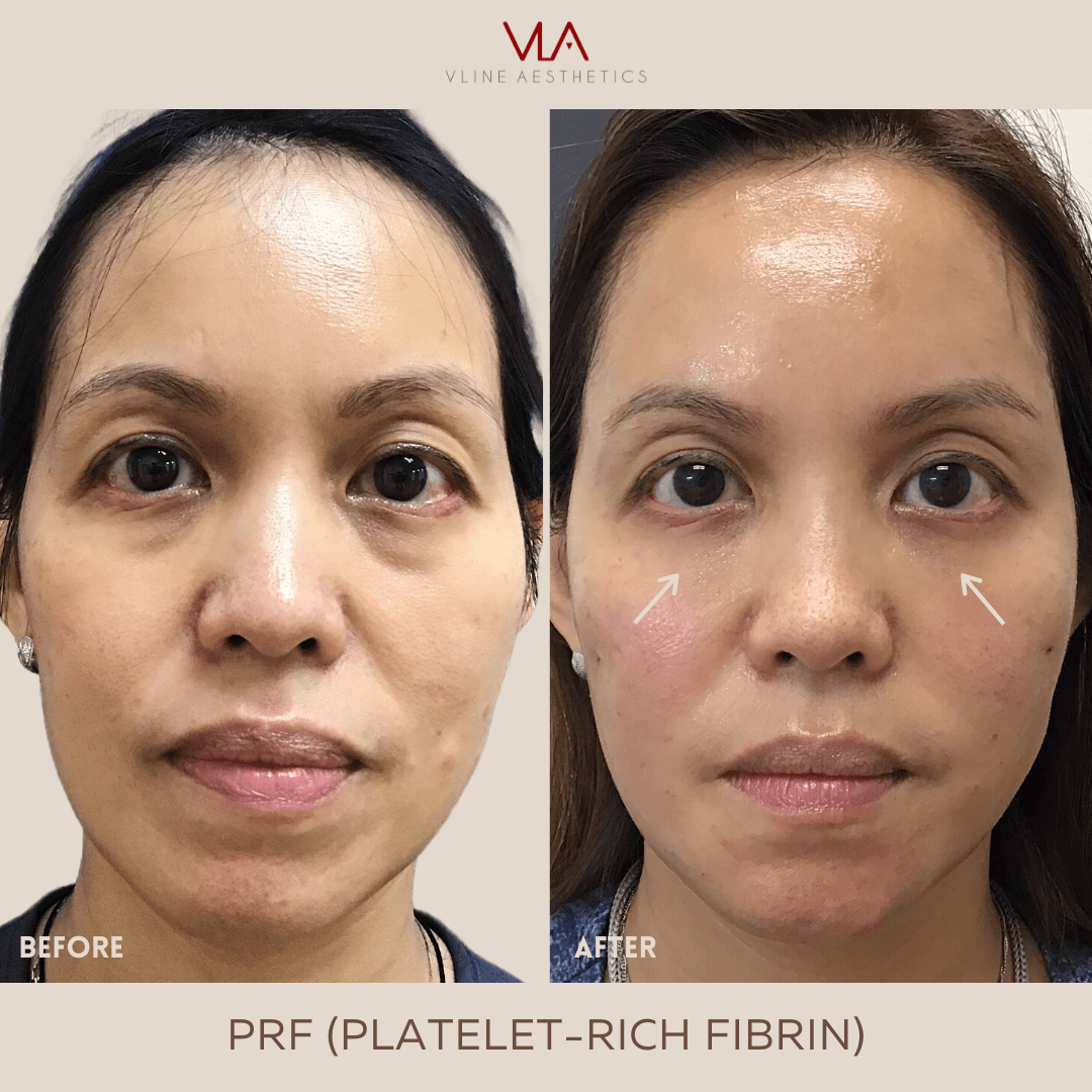 Platelet-Rich Fibrin (PRF) - Skin Perfect Brothers Powered by VLA