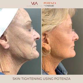 Potenza | RF Microneedling (Buy 2, Get 1 FREE) - Skin Perfect Brothers Powered by VLA