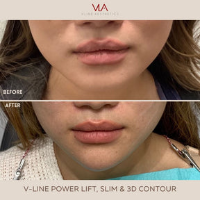 V-Line Power Slim / Xeomin - Skin Perfect Brothers Powered by VLA