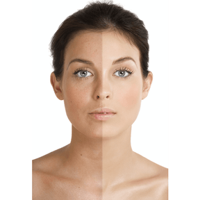 Sunspots / 1 Green Laser-Lasers-Skin Perfect Brothers