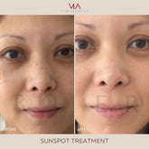 Sunspots / 1 Green Laser - Skin Perfect Brothers Powered by VLA