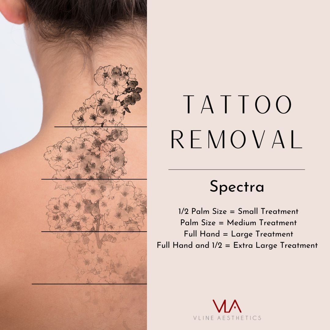 Tattoo Removal - Skin Perfect Brothers Powered by VLA