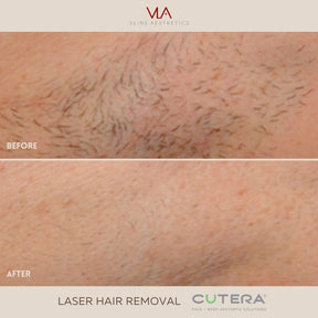 Laser Hair Removal Treatments - Skin Perfect Brothers Powered by VLA