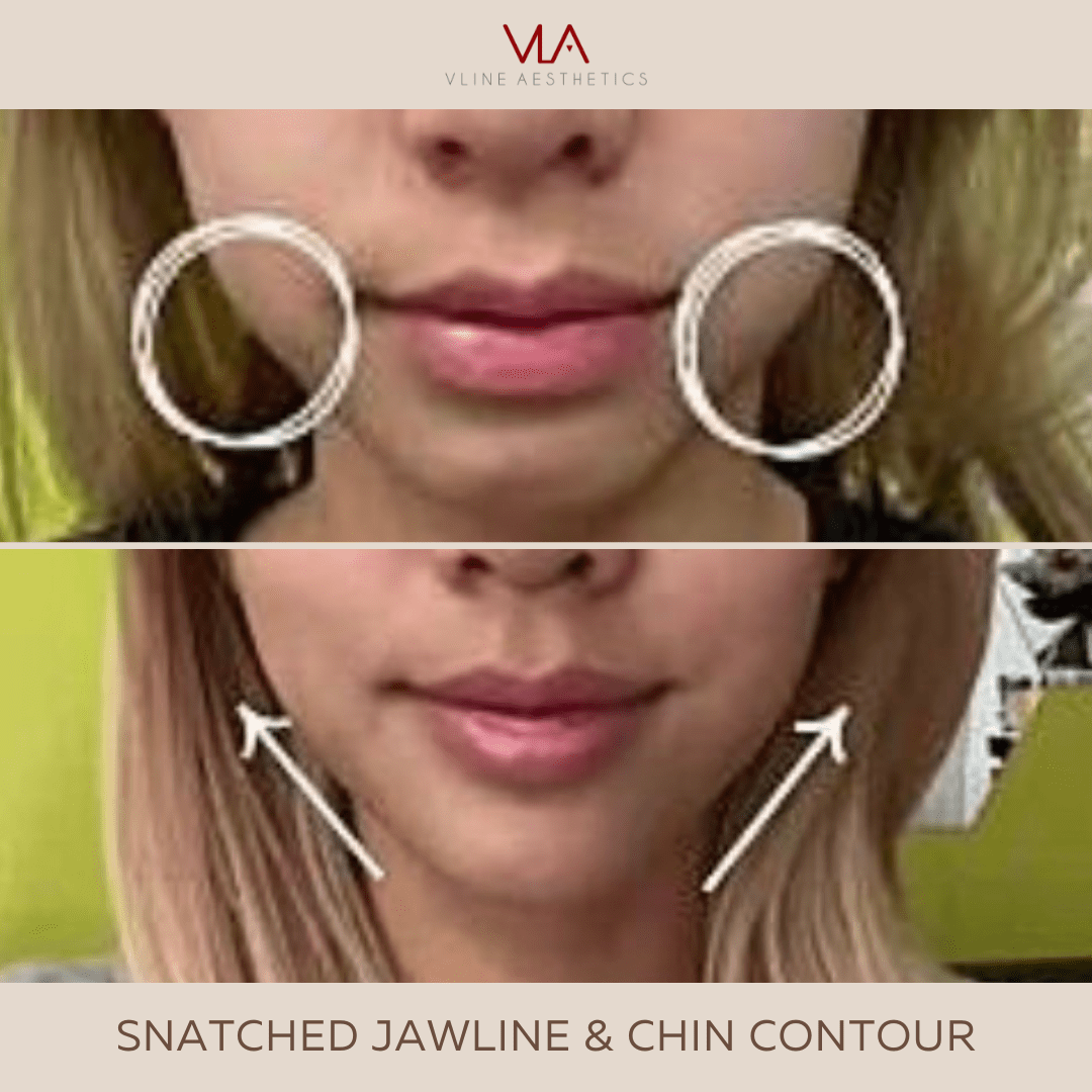 Chin Projection - Skin Perfect Brothers Powered by VLA
