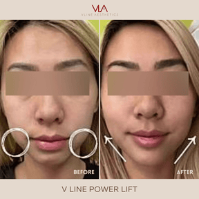 V-Line Power Lift | Lasts Up to a Year - Skin Perfect Brothers Powered by VLA