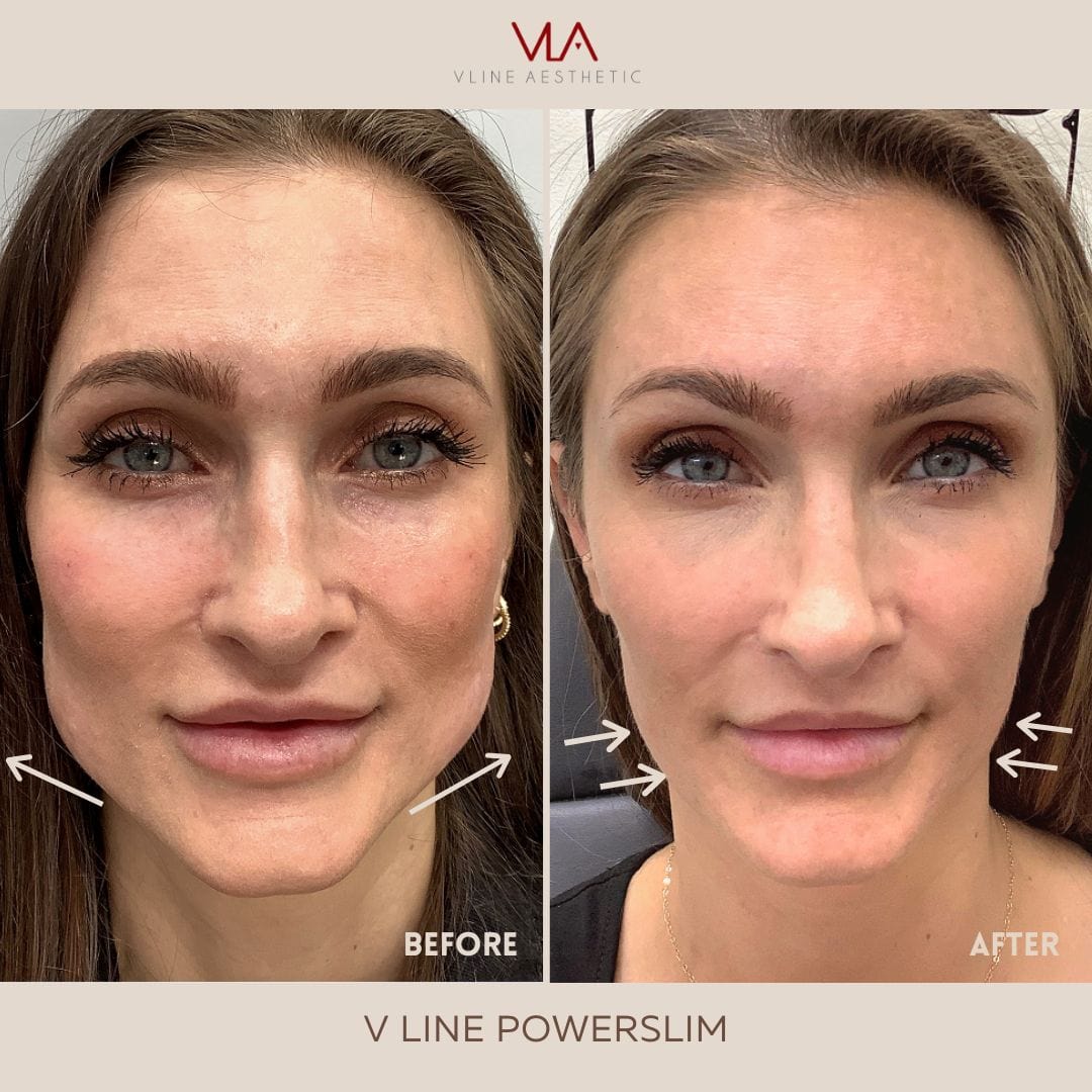 V-Line Power Slim / Xeomin - Skin Perfect Brothers Powered by VLA
