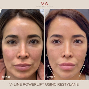 Chin Projection - Restylane Lyft - Skin Perfect Brothers Powered by VLA