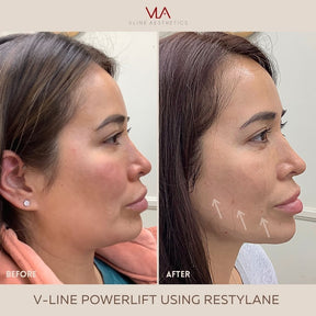 Collagen Lift & Xeomin Sale