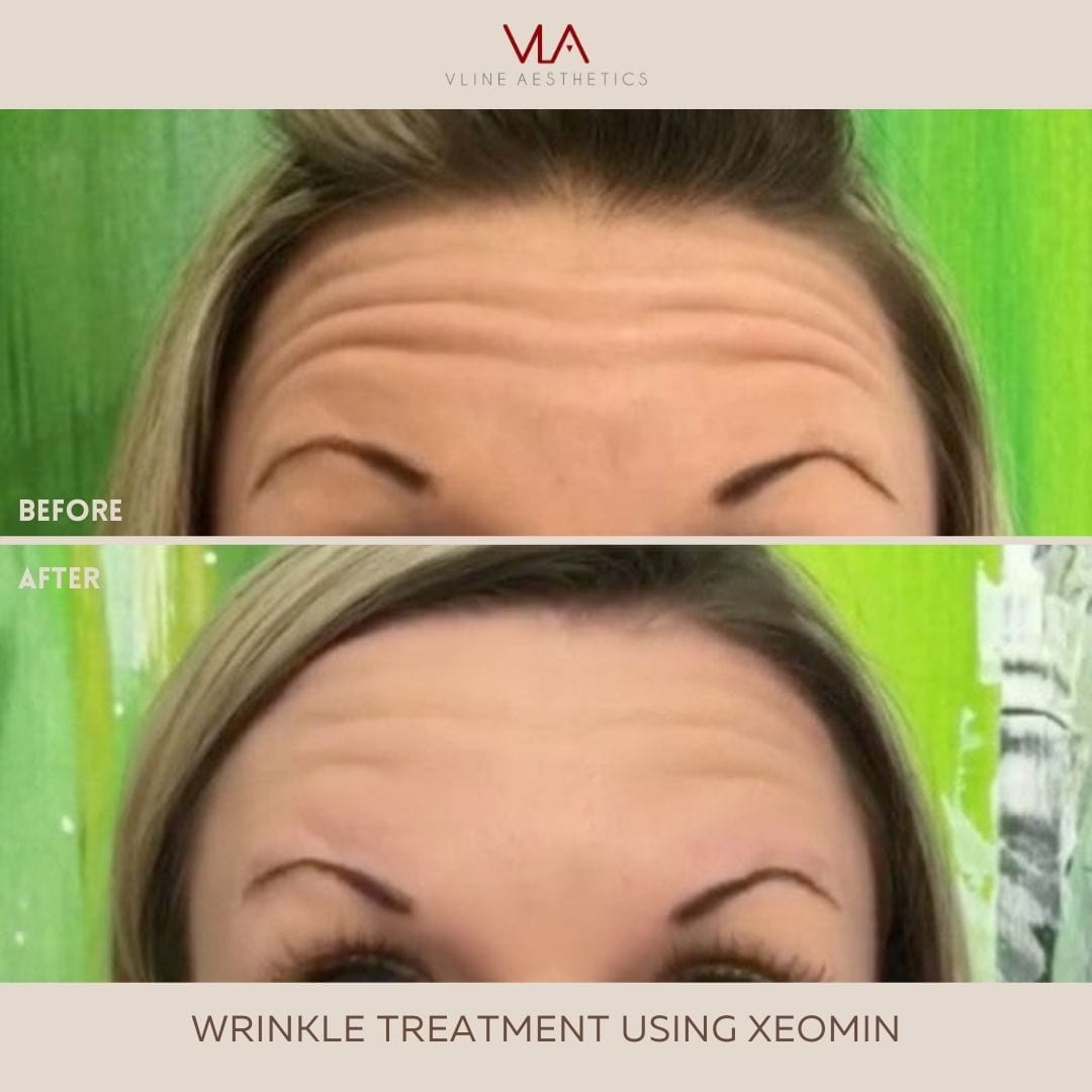 20, 40, 60, or 100 Units of Xeomin (More Pure than Botox) - Skin Perfect Brothers Powered by VLA