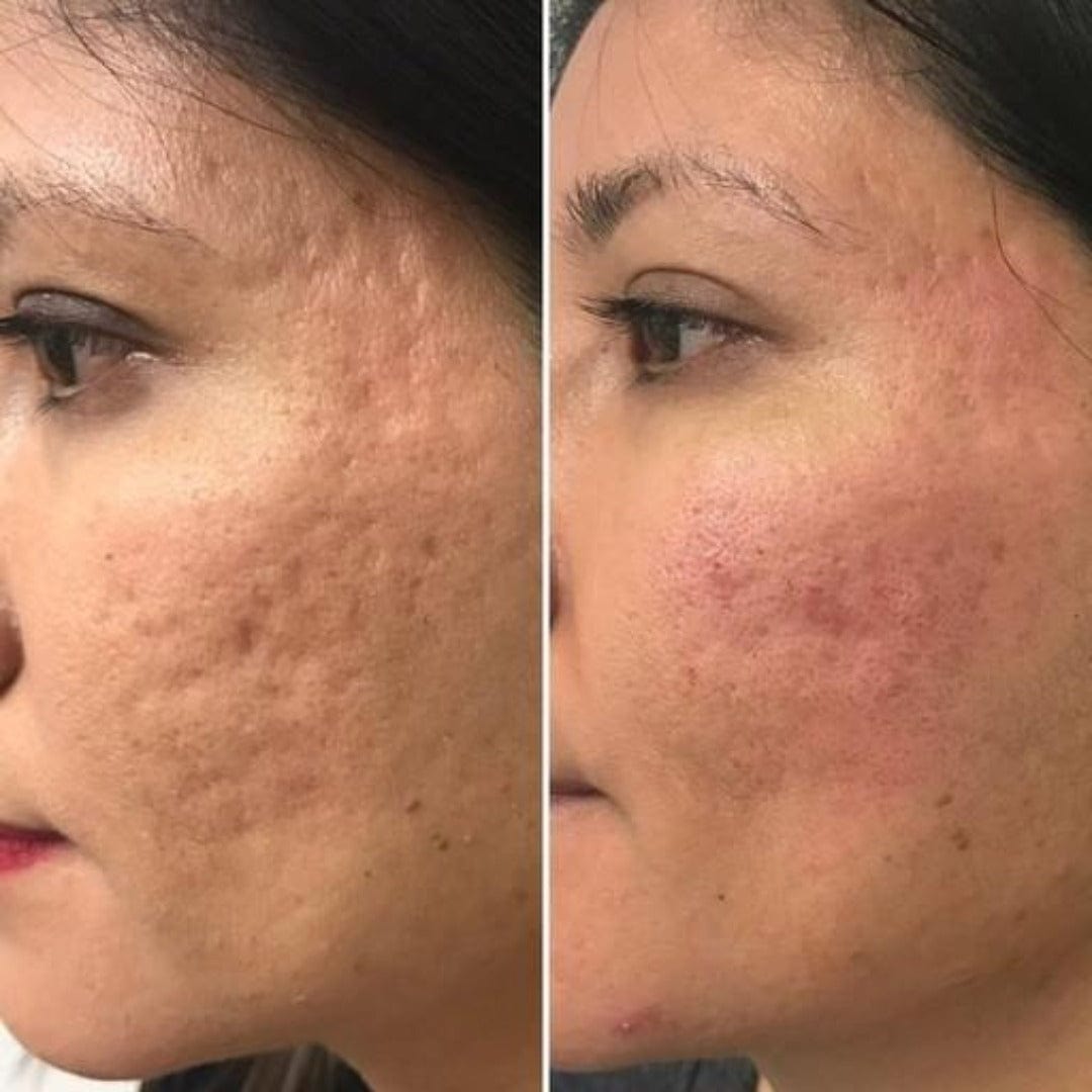 Acne Scars / 1 Bellafill