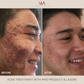 Acne scars, Wrinkles, Facial Rejuvenation / Laser Genesis + PMD Toner - Skin Perfect Brothers Powered by VLA