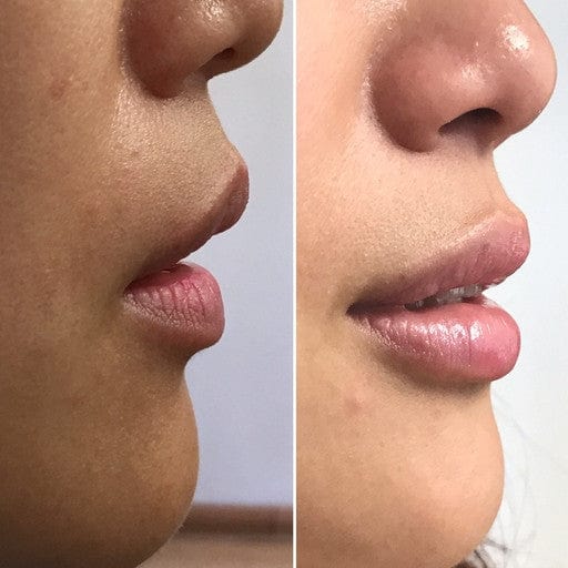 Lip Enhancement Augmentation-Injectables-Skin Perfect Brothers