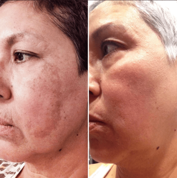 Melasma Laser Peel - Spectra Q Switch